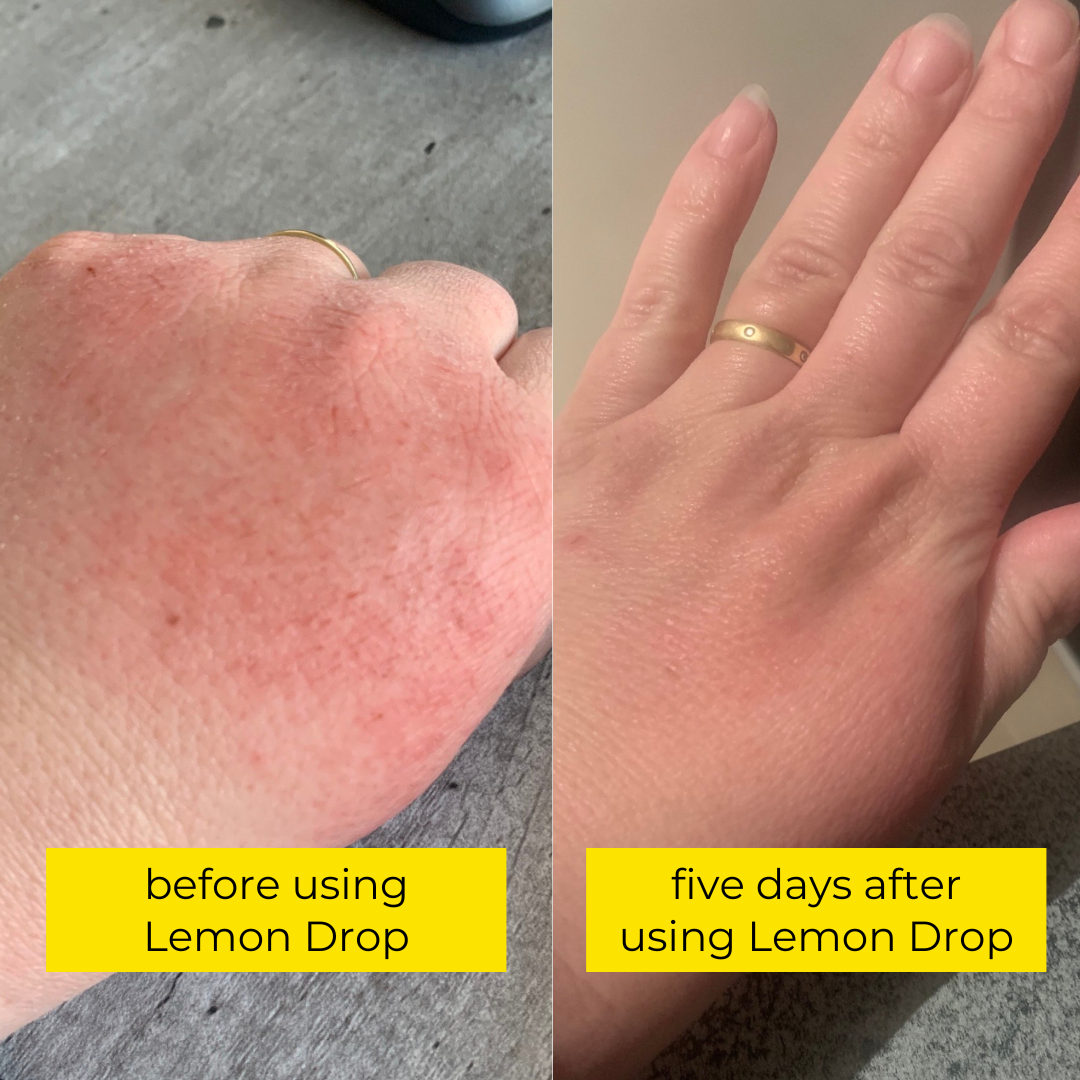 before and after using Bettyquette Lemon Drop, hand nail and cuticle oil